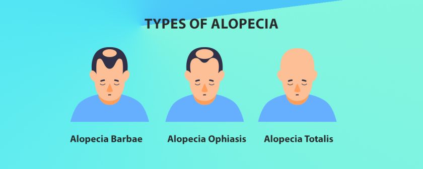 Understanding Alopecia Areata: Comprehensive Insights, Risk Factors, and Advanced Treatment Options